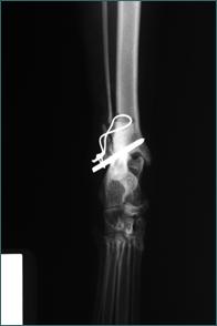 Referral, Greenmount, Veterinary, vet, disc, disease, prolapse, Orthopaedic, orthopedic, specialist, clinic, fractures, joint, surgery, arthroscopy, endoscopy, spinal, northern, ireland, OCD, FCP, TPO, cruciate ligament, tplo, hip, dysplasia, dislocation, medial, patellar, luxation, broken, leg, wobbler, caudal cervical spondylopathy, lumbar, paralysis,ACL, anterior cruciate ligament rupture, dislocated, dislocation, plating, pinning, external fixator, triple pelvic osteotomy, portadown, co armagh northern ireland, www.vetortho.co.uk, www.vetclinic.co.uk