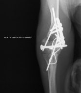 Referral, Greenmount, Veterinary, vet, disc, disease, prolapse, Orthopaedic, orthopedic, specialist, clinic, fractures, joint, surgery, arthroscopy, endoscopy, spinal, northern, ireland, OCD, FCP, TPO, cruciate ligament, tplo, hip, dysplasia, dislocation, medial, patellar, luxation, broken, leg, wobbler, caudal cervical spondylopathy, lumbar, paralysis,ACL, anterior cruciate ligament rupture, dislocated, dislocation, plating, pinning, external fixator, triple pelvic osteotomy, portadown, co armagh northern ireland, www.vetortho.co.uk, www.vetclinic.co.uk