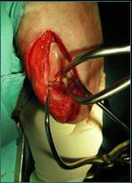 Referral, Greenmount, Veterinary, vet, disc, disease, prolapse, Orthopaedic, orthopedic, specialist, clinic, fractures, joint, surgery, arthroscopy, endoscopy, spinal, northern, ireland, OCD, FCP, TPO, cruciate ligament, tplo, hip, dysplasia, dislocation, medial, patellar, luxation, broken, leg, wobbler, caudal cervical spondylopathy, lumbar, paralysis,ACL, anterior cruciate ligament rupture, dislocated, dislocation, plating, pinning, external fixator, triple pelvic osteotomy, portadown, co armagh northern ireland, www.vetortho.co.uk, www.vetclinic.co.uk