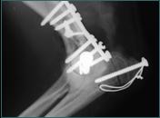 Referral, Greenmount, Veterinary, vet, disc, disease, prolapse, Orthopaedic, orthopedic, specialist, clinic, fractures, joint, surgery, arthroscopy, endoscopy, spinal, northern, ireland, OCD, FCP, TPO, cruciate ligament, tplo, hip, dysplasia, dislocation, medial, patellar, luxation, broken, leg, wobbler, caudal cervical spondylopathy, lumbar, paralysis,ACL, anterior cruciate ligament rupture, dislocated, dislocation, plating, pinning, external fixator, triple pelvic osteotomy, portadown, co armagh northern ireland, www.vetortho.co.uk, www.vetclinic.co.uk