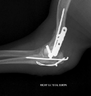 Referral, Greenmount, Veterinary, vet, disc, disease, prolapse, Orthopaedic, orthopedic, specialist, clinic, fractures, joint, surgery, arthroscopy, endoscopy, spinal, northern, ireland, OCD, FCP, TPO, cruciate ligament, tplo, hip, dysplasia, dislocation, medial, patellar, luxation, broken, leg, wobbler, caudal cervical spondylopathy, lumbar, paralysis,ACL, anterior cruciate ligament rupture, dislocated, dislocation, plating, pinning, external fixator, triple pelvic osteotomy, portadown, co armagh northern ireland, www.vetortho.co.uk, www.vetclinic.co.uk