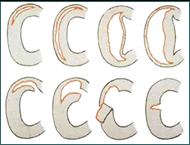 Referral, Greenmount, Veterinary, vet, disc, disease, prolapse, Orthopaedic, orthopedic, specialist, clinic, fractures, joint, surgery, arthroscopy, endoscopy, spinal, northern, ireland, OCD, FCP, TPO, cruciate ligament, tplo, hip, dysplasia, dislocation, medial, patellar, luxation, broken, leg, wobbler, caudal cervical spondylopathy, lumbar, paralysis,ACL, anterior cruciate ligament rupture, dislocated, dislocation, plating, pinning, external fixator, triple pelvic osteotomy, portadown, co armagh northern ireland, www.vetortho.co.uk, www.vetclinic.co.uk