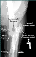 Referral, Greenmount, Veterinary, vet, disc, disease, prolapse, Orthopaedic, orthopedic, specialist, clinic, fractures, joint, surgery, arthroscopy, endoscopy, spinal, northern, ireland, OCD, FCP, TPO, cruciate ligament, tplo, hip, dysplasia, dislocation, medial, patellar, luxation, broken, leg, wobbler, caudal cervical spondylopathy, lumbar, paralysis,ACL, anterior cruciate ligament rupture, dislocated, dislocation, plating, pinning, external fixator, triple pelvic osteotomy, portadown, co armagh northern ireland, www.vetortho.co.uk, www.vetclinic.co.uk