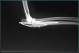 Referral, Greenmount, Veterinary, vet, disc, disease, prolapse, Orthopaedic, orthopedic, specialist, clinic, fractures, joint, surgery, arthroscopy, endoscopy, spinal, northern, ireland, OCD, FCP, TPO, cruciate ligament, tplo, hip, dysplasia, dislocation, medial, patellar, luxation, broken, leg, wobbler, caudal cervical spondylopathy, lumbar, paralysis,ACL, anterior cruciate ligament rupture, dislocated, dislocation, plating, pinning, external fixator, triple pelvic osteotomy, portadown, co armagh northern ireland, www.vetortho.co.uk, www.vetclinic.co.uk