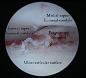 Referral, Greenmount, Veterinary, vet, disc, disease, prolapse, Orthopaedic, orthopedic, specialist, clinic, fractures, joint, surgery, arthroscopy, endoscopy, spinal, northern, ireland, OCD, FCP, TPO, cruciate ligament, tplo, hip, dysplasia, dislocation, medial, patellar, luxation, broken, leg, wobbler, caudal cervical spondylopathy, lumbar, paralysis,ACL, anterior cruciate ligament rupture, dislocated, dislocation, plating, pinning, external fixator, triple pelvic osteotomy, portadown, co armagh northern ireland, www.vetortho.co.uk, www.vetclinic.co.uk