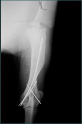 Referral, Greenmount, Veterinary, vet, disc, disease, prolapse, Orthopaedic, orthopedic, specialist, clinic, fractures, joint, surgery, arthroscopy, endoscopy, spinal, northern, ireland, OCD, FCP, TPO, cruciate ligament, tplo, hip, dysplasia, dislocation, medial, patellar, luxation, broken, leg, wobbler, caudal cervical spondylopathy, lumbar, paralysis,ACL, anterior cruciate ligament rupture, dislocated, dislocation, plating, pinning, external fixator, triple pelvic osteotomy, portadown, co armagh northern ireland, www.vetortho.co.uk, www.vetclinic.co.uk